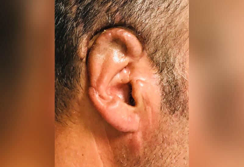 Qopan qulağı 34 saat sonra yerinə tikildi