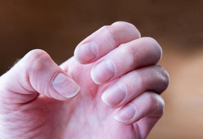 Ölümcül xəstəliyin gizli əlaməti