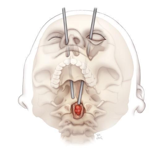 Bədənindəki şiş xəstənin gözündən çıxarıldı