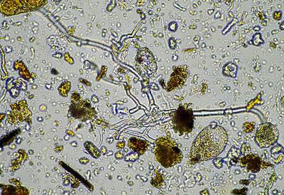 Женщина заразилась неизлечимой болезнью из-за стакана водопроводной воды