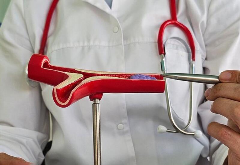 Врач рассказал о первых признаках образования тромбов