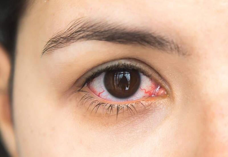 Врач назвала связанные с покраснением глаз болезни