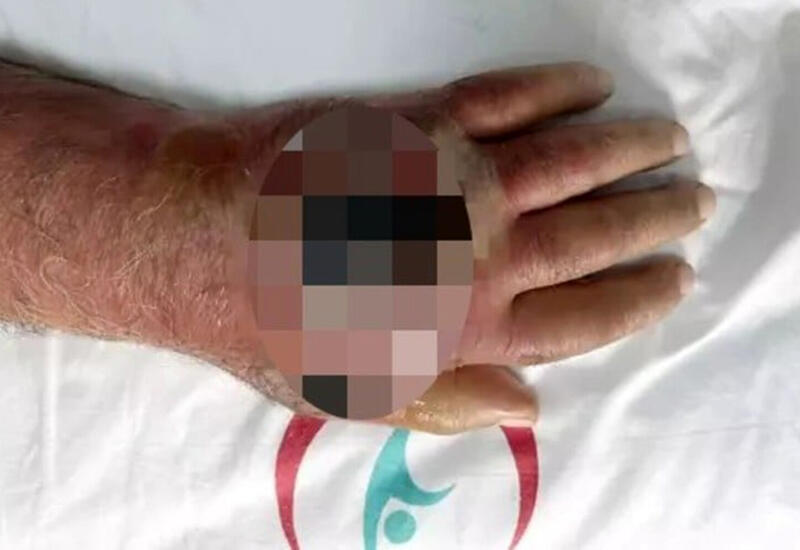 Мужчина едва не лишился руки из-за вора, укусившего его во время ограбления