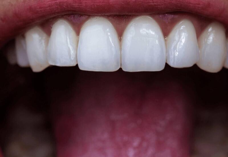 Dişləri evdə tez ağartmaq üsulları