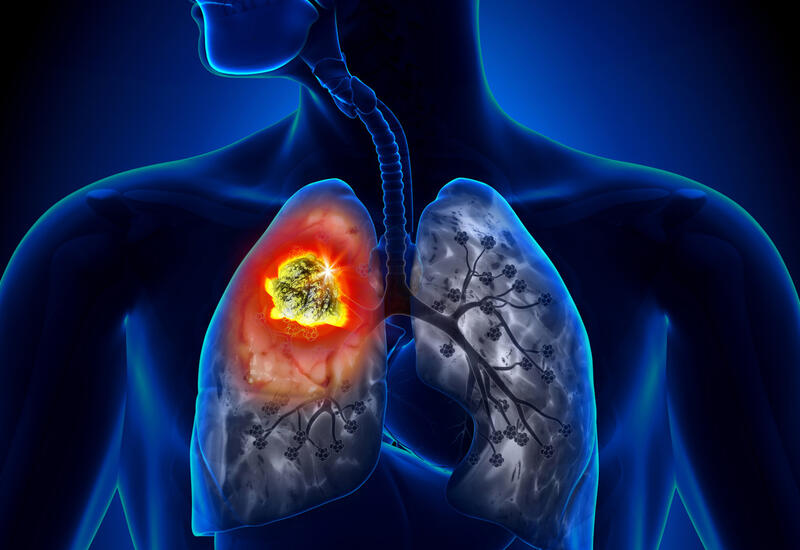 Почему рак груди часто метастазирует в легкие?