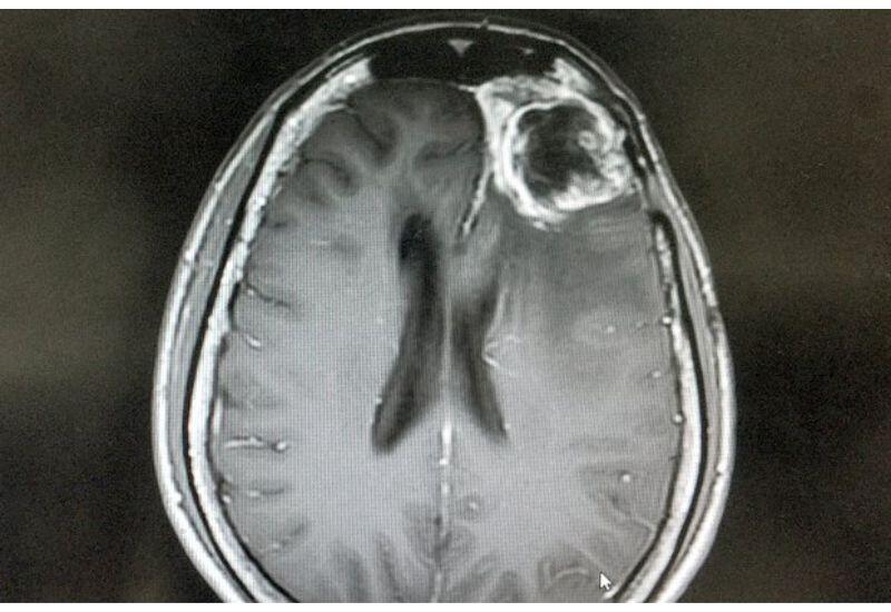 Найден способ замедлить рост агрессивного рака