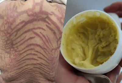 На коже женщины после самолечения появились змеиные узоры