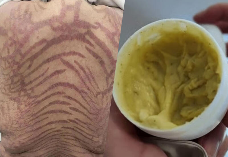 На коже женщины после самолечения появились змеиные узоры