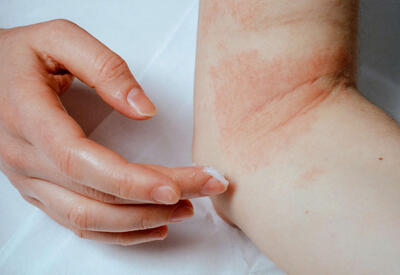 Распространенное кожное заболевание оказалось опасным для психики