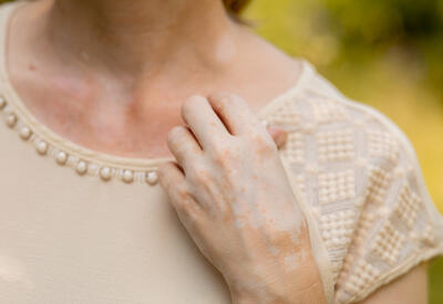Дерматолог рассказала о неочевидных причинах появления пигментации после лета