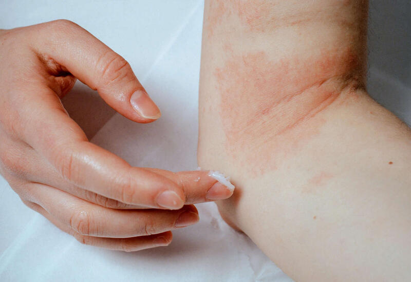 Распространенное кожное заболевание оказалось опасным для психики