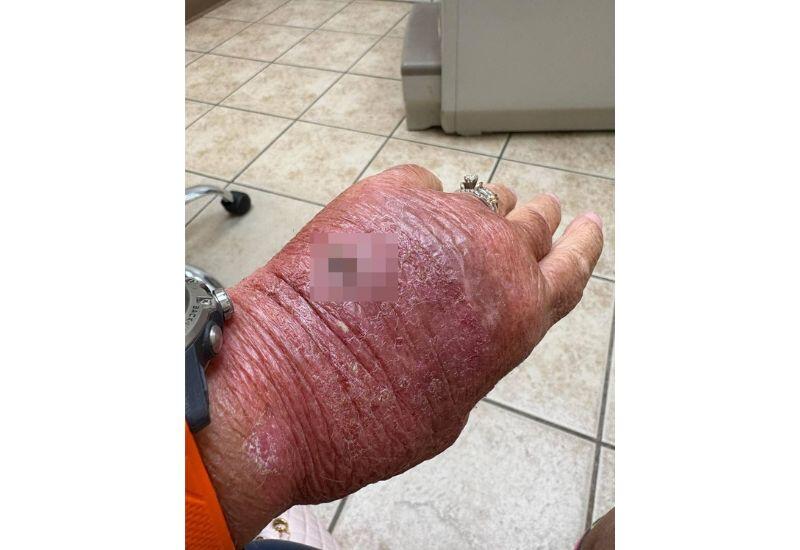 Женщина едва не лишилась руки, случайно порезав ее картоном