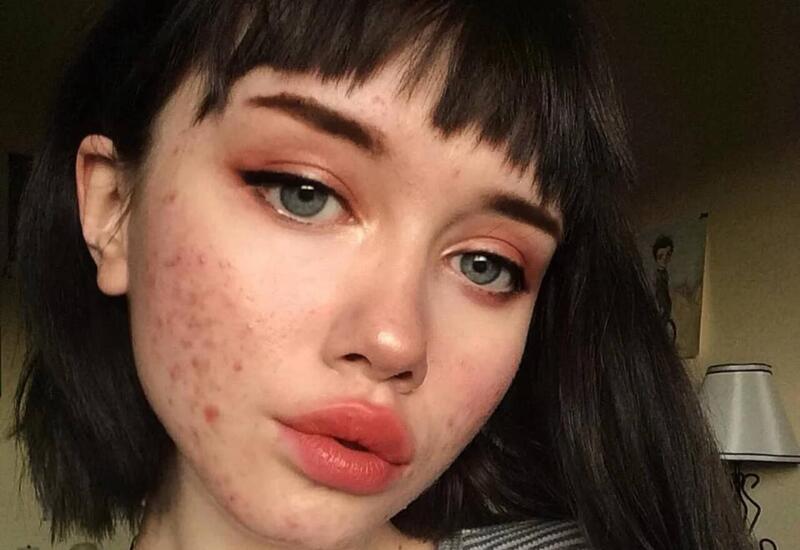 Sızanaqların yaranmasının gözlənilməz səbəbi açıqlandı