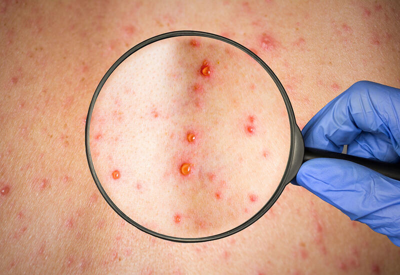 Ученые предупредили о росте вспышек кори