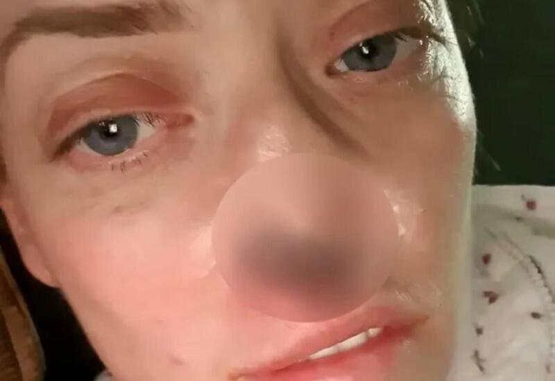 Türkiyədə implant etdirən qadının burnu çürüməyə başladı