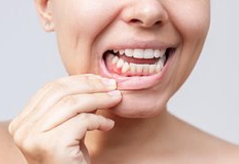 Названа неожиданная связь между здоровьем десен и болезнями сердца