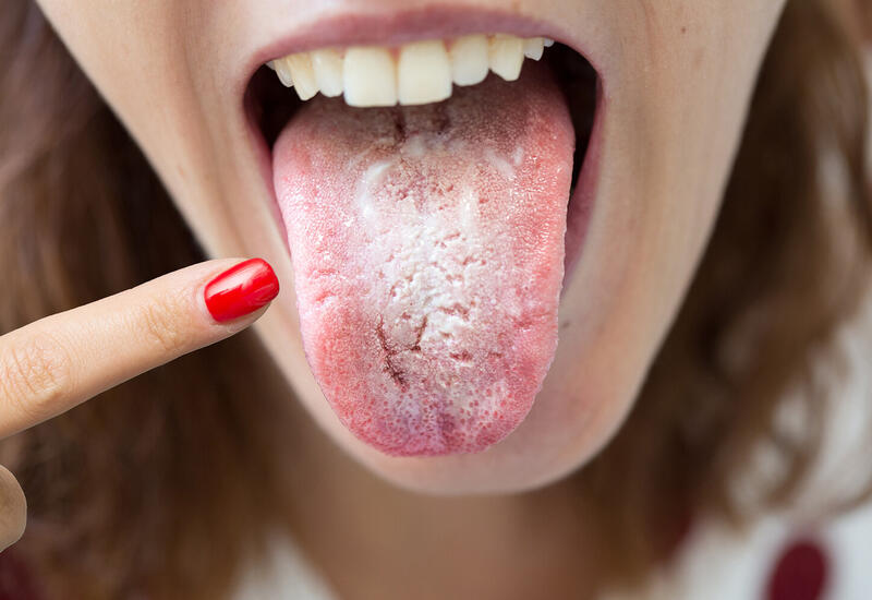Названа опасная причина пятен на языке