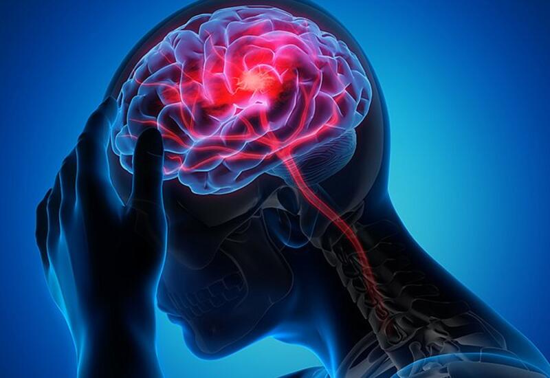 Назван неочевидный признак инсульта