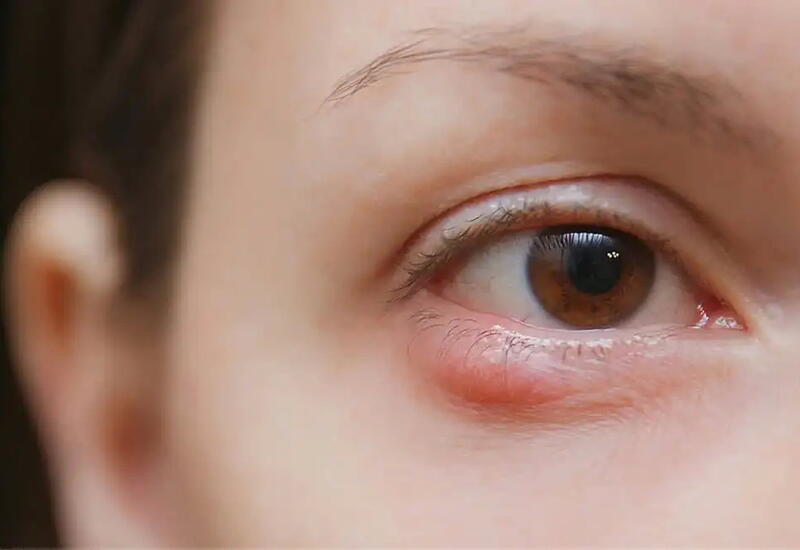 Назван скрытый фактор риска глазных заболеваний