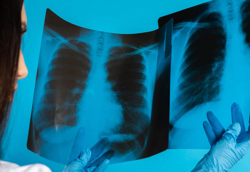 Названы три группы людей с высоким риском рака легких
