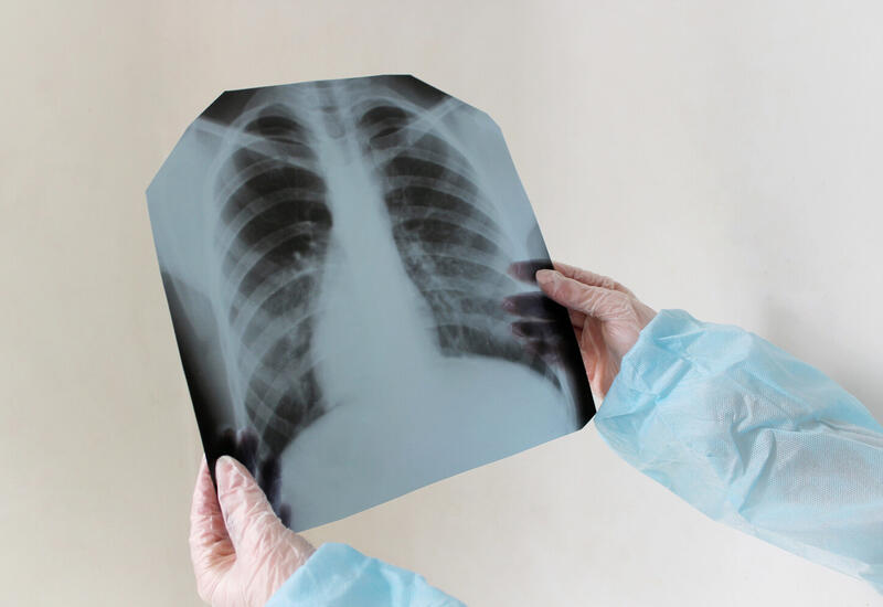 В европейской стране зафиксировали резкий рост заболеваемости туберкулезом