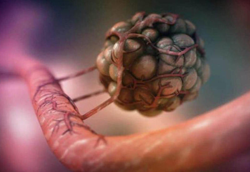 Xərçəng müalicəsində yeni dövr