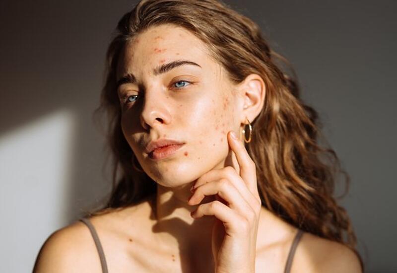 Дерматолог объяснил связь прыщей на лбу и стресса