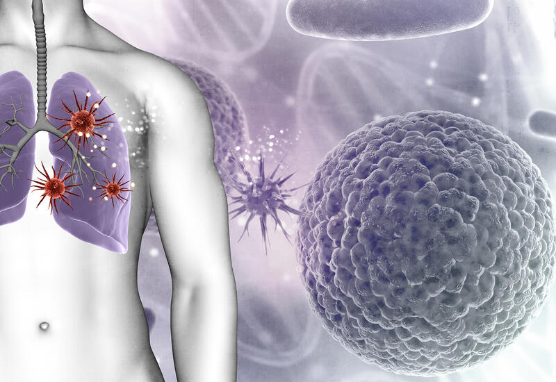 Названа группа продуктов, повышающая риск развития рака легких
