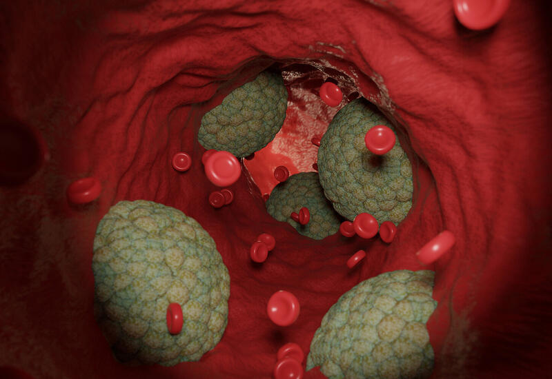 Назван возможный фактор быстрого формирования бляшек в сосудах