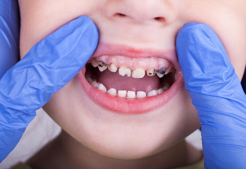 Врач назвала главные ошибки родителей при уходе за детскими зубами