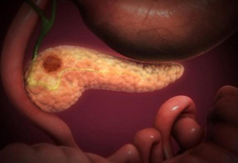 Ученые выяснили, как предрак поджелудочной обманывает иммунную систему