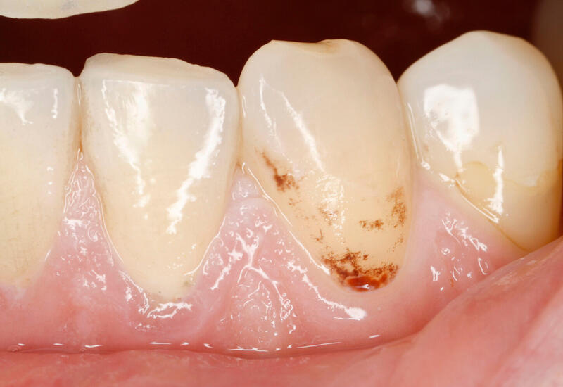 Найден неожиданный способ предотвратить кариес