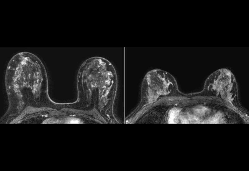 Бактерия полости рта может повышать риск рака груди