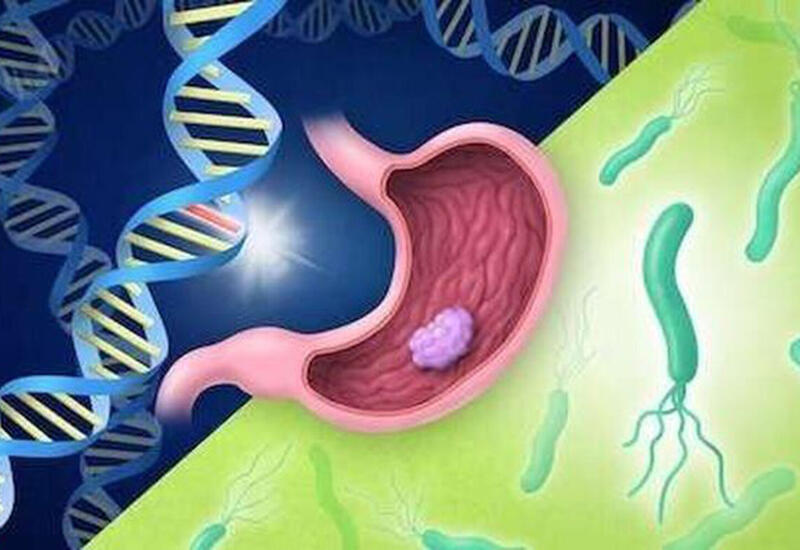 Развеян распространенный миф о причине рака желудка