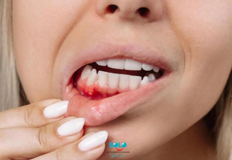 Sadə görünür, amma təhlükəlidir - Diş əti qanaması nəyin xəbəridir?