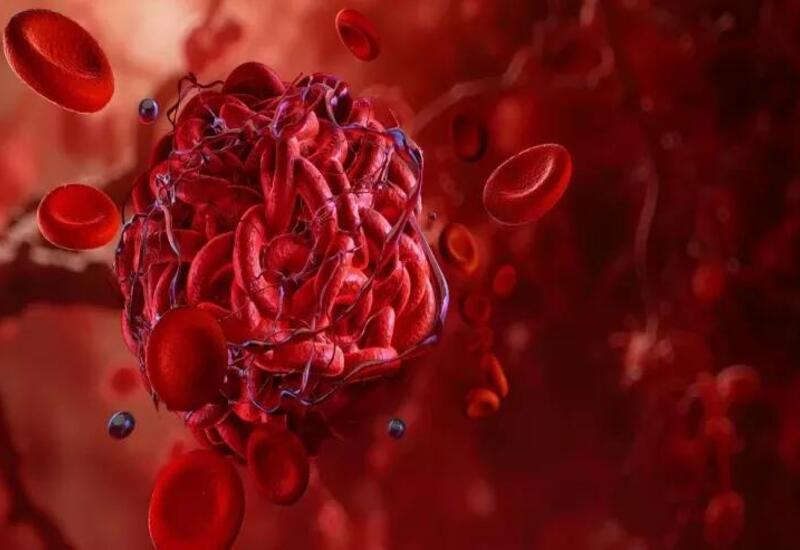 Tromb ola biləcəyini göstərən əsas narahatedici