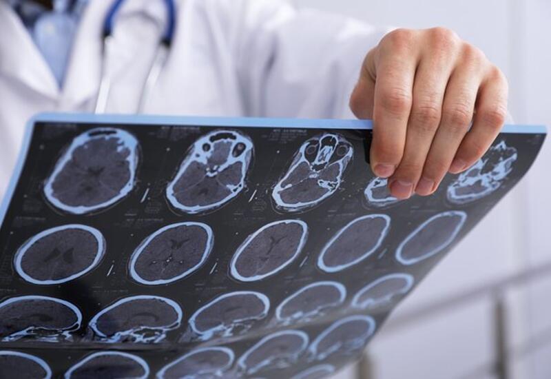 Выявлен неожиданный фактор развития опухоли мозга