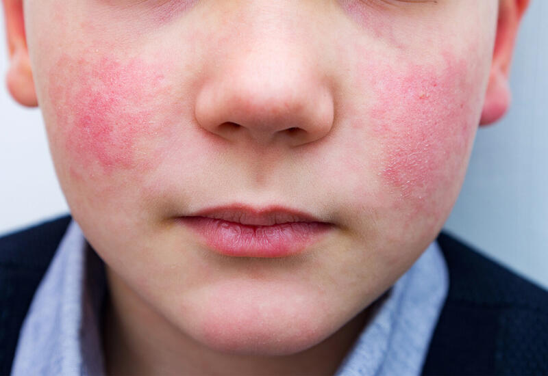 Ученые развеяли миф о детской аллергии