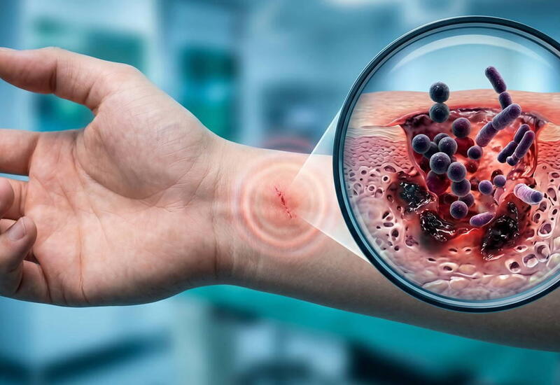 "Ət yeyən bakteriya"