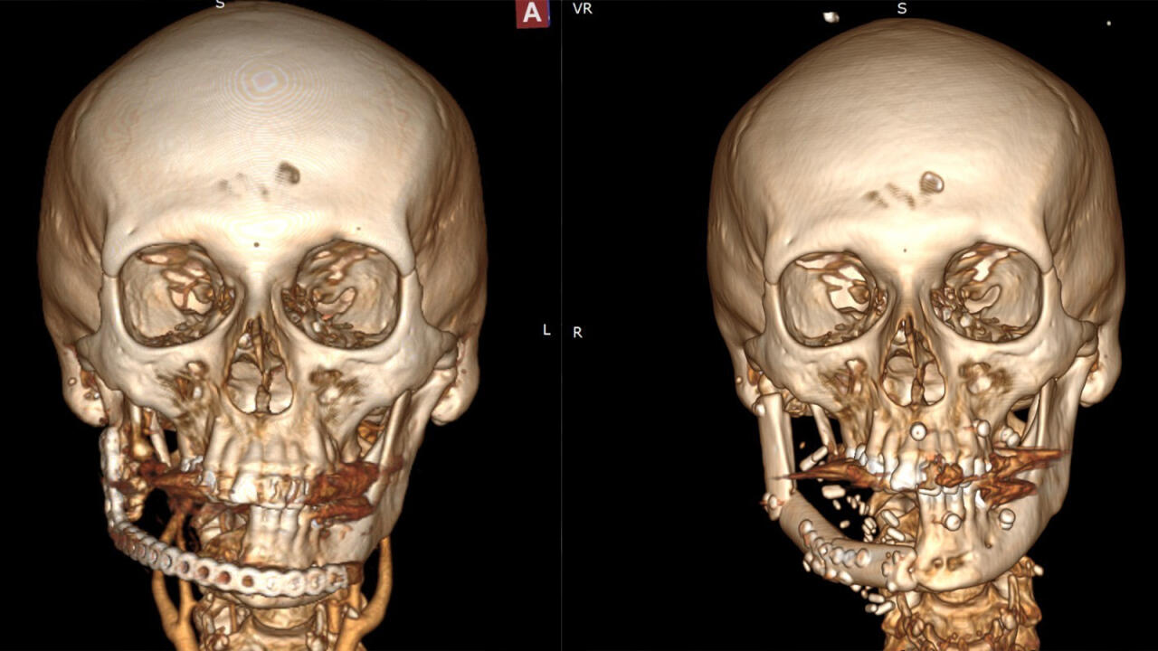 Уникальная 10-часовая операция от Министерства здравоохранения Азербайджана: пациенту была сформирована новая челюсть из собственной кости