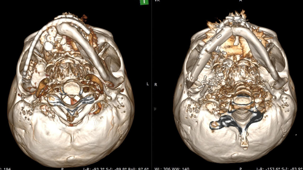 Уникальная 10-часовая операция от Министерства здравоохранения Азербайджана: пациенту была сформирована новая челюсть из собственной кости