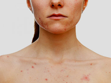 О чем свидетельствует сыпь на лице и шее