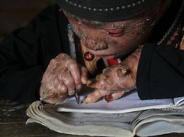 Мальчик-змея каждые два дня сбрасывает свою кожу - ФОТО