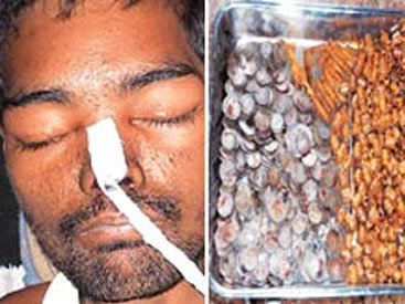 Хирурги обнаружили в желудке пациента необычное содержимое