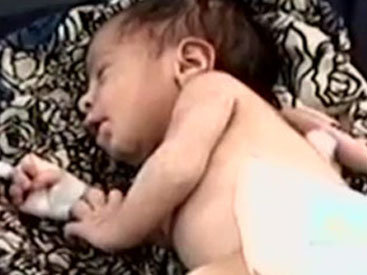 В Пакистане родилась девочка с третьей рукой на спине - ВИДЕО