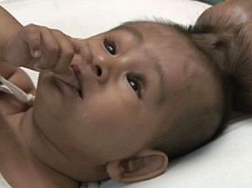 Шок: в Индии родился мальчик с двумя головами - ОБНОВЛЕНО - ВИДЕО - ФОТО