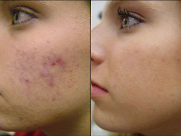 Как избавиться от угрей?