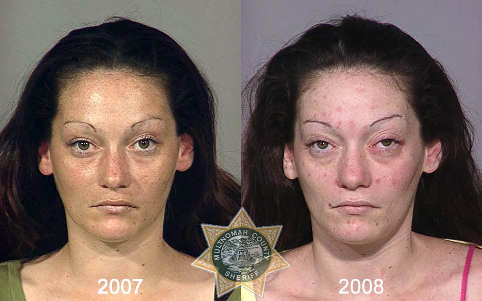 Ужасные последствия употребления наркотиков - ФОТОСЕССИЯ