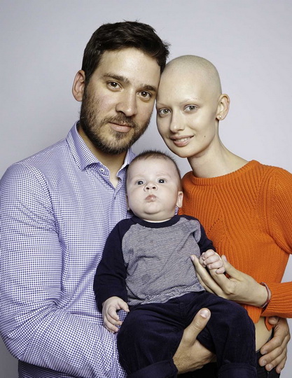 Невероятные фотографии модели, потерявшей челюсть из-за рака - ФОТО