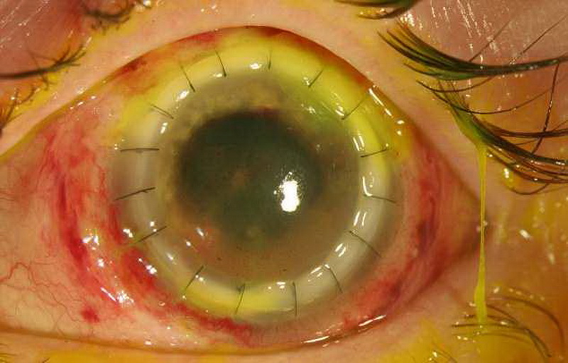 Ужас: бактерии съели глазные яблоки девушки - ФОТО